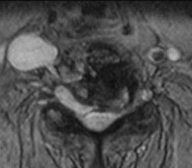 Figura 3 RM mostrando componente tumoral paravertebral
