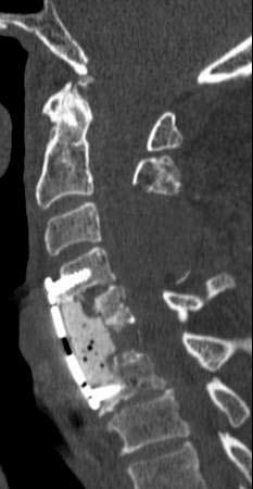 Com esses resultados associados à idade do doente, foram colocadas as hipóteses de metástase, nomeadamente de carcinoma renal ou da tiroide,