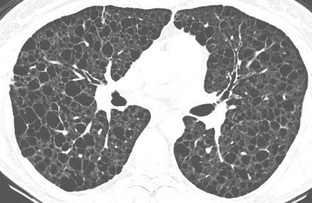 35 Os cistos pulmonares (Figura 1) são considerados os marcadores característicos desta doença e estão presentes em 100% das pacientes.