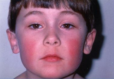 Gabriel, 6 anos Há 6 dias teve 2 dias de febre, mal estar, cefaleia e dor nos olhos. Há 2 dias as bochechas começaram a ficar vermelhas.