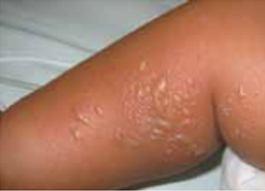 Lactente com exantema bolhoso por Chikungunya CDC.