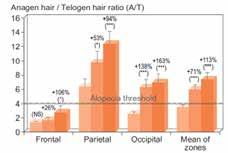 Nas mulheres a queda de cabelo não acontece de maneira uniforme, o que implica em perda no volume total, porém sem ocasionar a diminuição da linha frontal do cabelo.