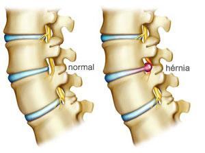 6 A hérnia de disco surge como resultado de diversos pequenos traumas na coluna que vão, com o passar do tempo, lesando as estruturas do disco intervertebral, ou pode acontecer como consequência de