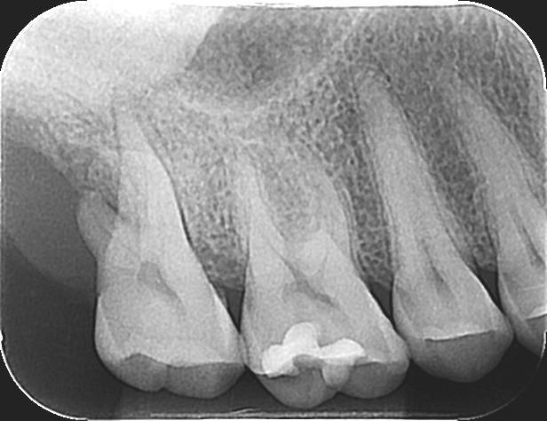 A consequência clássica decorrente dessa intercorrência operatória é a deficiência de neoformação de tecido ósseo próximo a raiz distal do elemento dental remanescente, resultando em mobilidade,