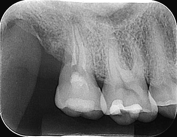 fosfórico à 37%, aplicação de adesivo dentinário, e fotopolimerização por 20 segundos e vedamento da embocadura do canal disto-vestibular com Resina Composta (3M ESPE, St.