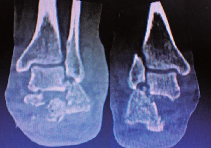 Figura 4. Imagens da Tomografia Computadorizada em corte coronal evidenciando luxação do corpo do calcâneo lateralmente sob a fíbula.. Direito.. Esquerdo. Figura 5.