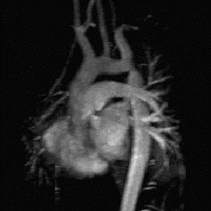 Doença Cardíaca Congénita e Grandes Vasos A RM possibilita um adequado estudo da morfologia do coração e dos grandes vasos.