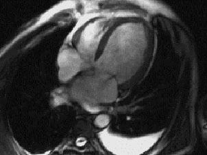 Em ambas as situações a RM permite a avaliação morfológica demonstrando a dilatação auricular e da veia cava. Possibilita ainda a avaliação funcional do VE.