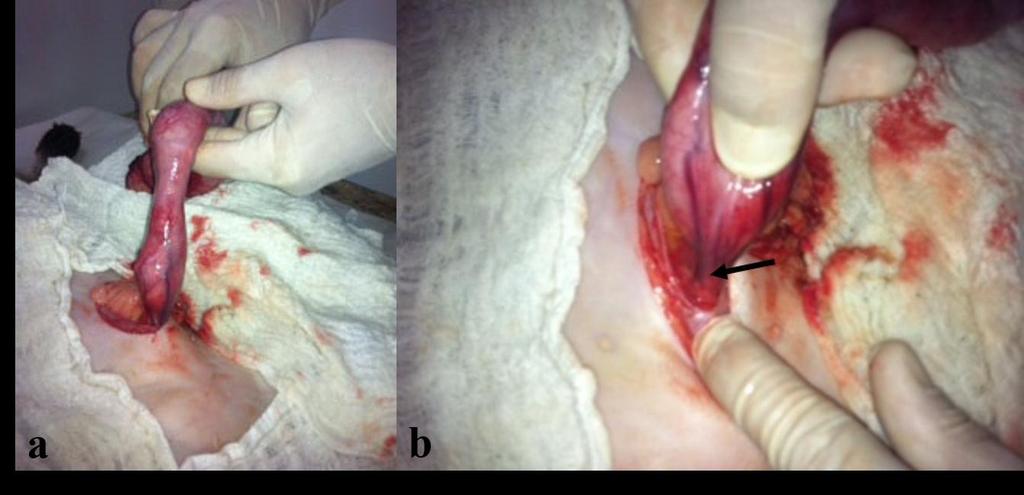 19 seguida colocaram-se três pinças Crile curvas no corpo uterino e foi feita incisão entre a pinça mais distal e média, com colocação de duas ligaduras transfixantes.