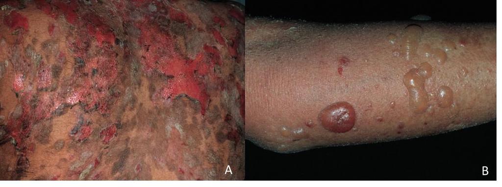 (HE. 40X) Dermatoses bolhosas subepidérmicas: a clivagem ocorre na região subepidérmica.