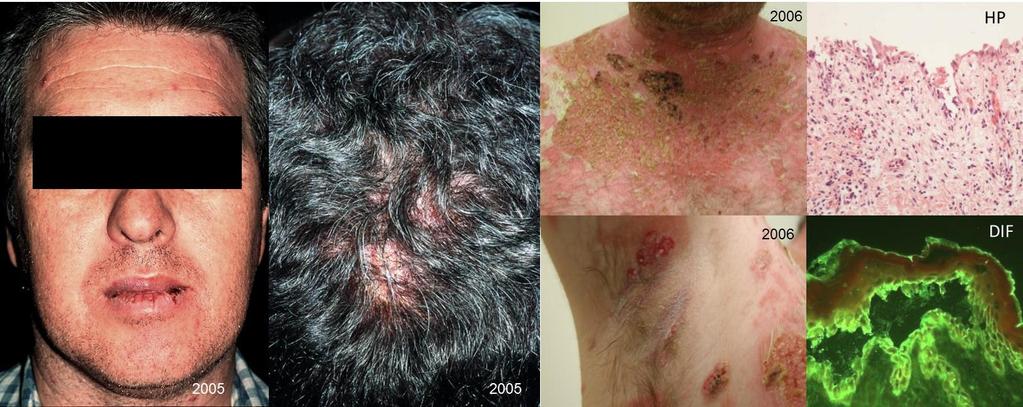 Resultados 40 Figura 12. Paciente 3. Lesões cutâneo mucosas no diagnóstico inicial de PV (outubro de 2003), apresentou exacerbação da doença em 2006.