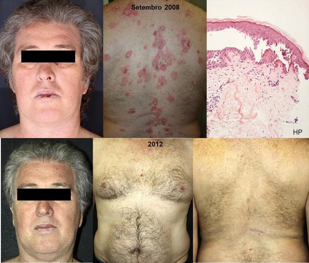 Resultados 41 Figura 14. Paciente 3. Retorno de aspecto de PV em setembro de 2008: lesões mucosas e clivagem suprabasal à histopatologia.