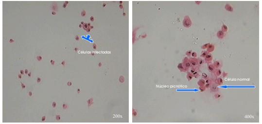 Efeito citopático produzido por poliovírus e outros picornavírus: as células apresentam-se pequenas, com