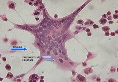 400x Efeito citopático produzido pelo vírus do Herpes simplex: as células infectadas apresentam-se mono ou multinucleadas (sincícios), com núcleos
