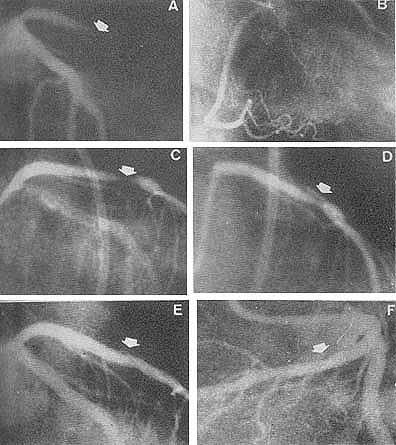 cintigrafia cardíaca com tálio-201 Fig. 1 - Caso 7, L.P.S. - Paciente exibia angina espástica.