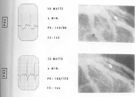 cintigrafia cardíaca com tálio-201 Fig. 3 - Caso 16, R.B.A.