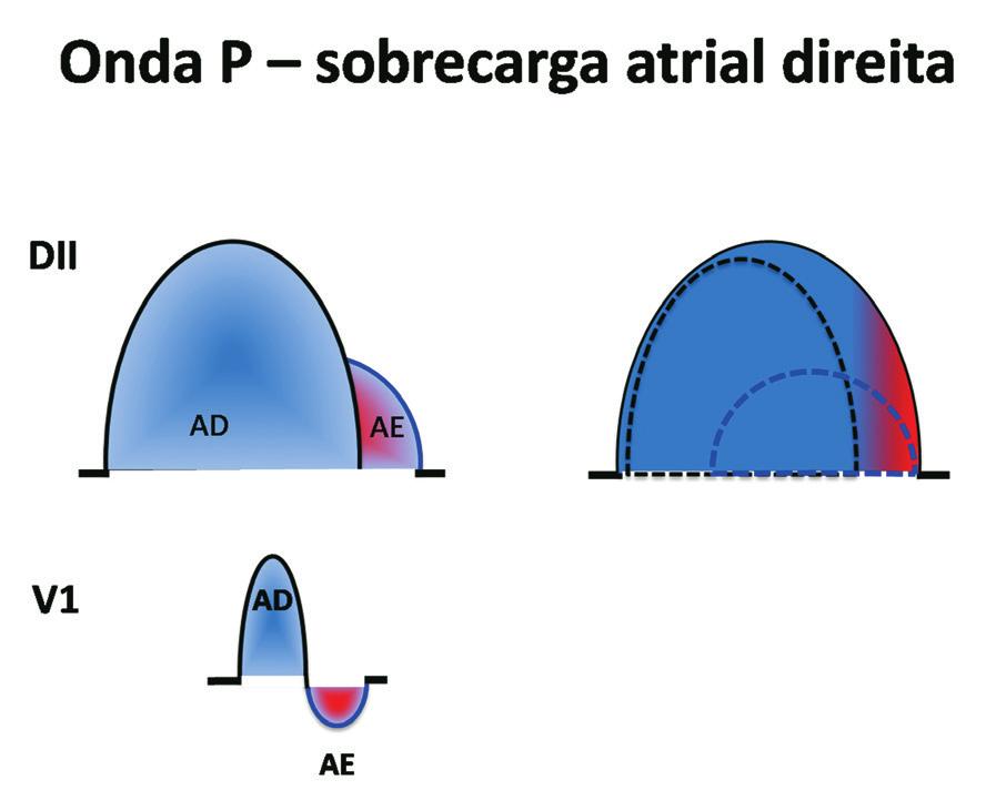 52 ABC do ECG O eletrocardiograma apresenta alta especificidade (96 a 100%), embora a sensibilidade seja baixa (de 7 a 10%).