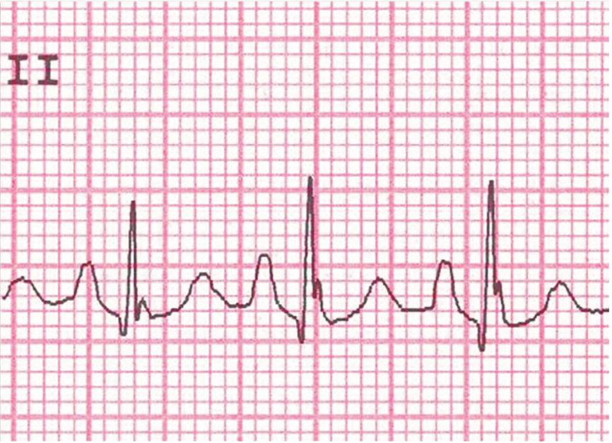 Deste modo, as alterações provocadas pela sobrecarga atrial direita nos parâmetros da onda P são (Figuras 2; 3 A a D): - Aumento da amplitude da onda P 2,5mm (duração constante), mais evidente em