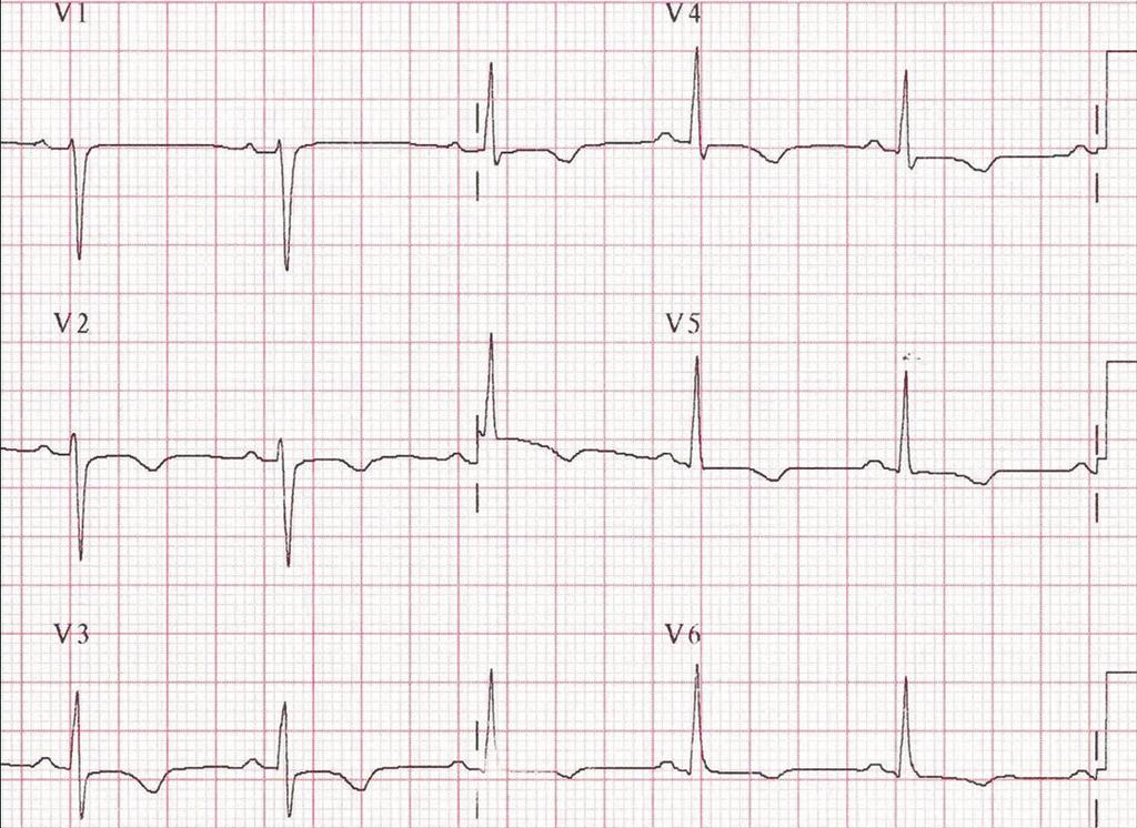 114 ABC do ECG Figura 1 - Isquemia Figura 2