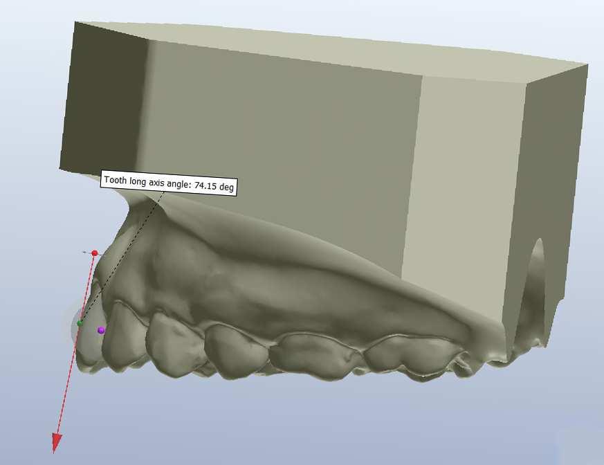 Material e Métodos 35 105,85º Figura 9 Imagem ilustrando dente 21 com inclinação visualmente superior a 90º. Foi necessário fazer o cálculo da suplementação do ângulo.