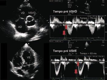 Obs: VTI: integral da velocidade pelo tempo; VSVE: via de saída do ventrículo esquerdo; VSVD: via de saída do ventrículo direito (Adaptado de Bertini et al 3, com a permissão dos autores).