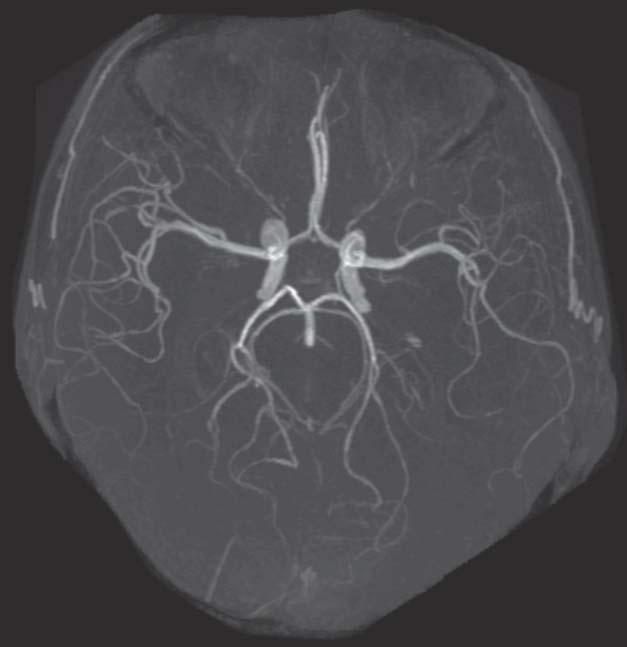 Imagens da Cabeça (VRM Venografia por Ressonância Magnética e ARM Arteriografia por Ressonância Magnética) Arteriografia por ressonância magnética (ARM) no nível do círculo arterial do cérebro (de