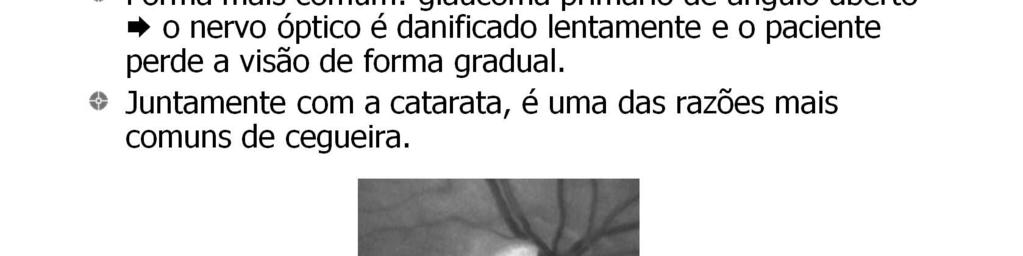 O olho humano produz continuamente um fluido para nutrição de estruturas do segmento anterior: o humor aquoso.