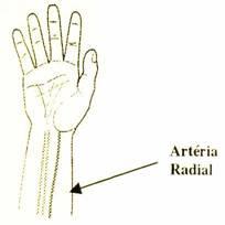 Locais para canulação: A artéria radial é a mais comum