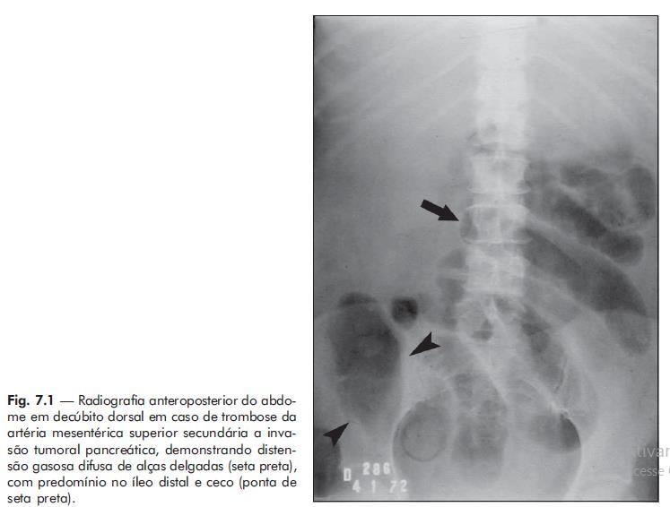 4 Radiografia contrastada Na suspeita do abdome agudo