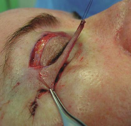 seguido de hemostasia e sutura contínua com o mesmo fio anterior na região infraciliar, semelhante à blefaroplastia pela
