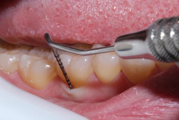 A C B Figura 3. A. Teste de vitalidade pulpar térmico ao frio; B. Sondagem de bolsa periodontal; C.