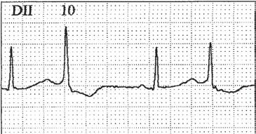 SOBRAC em Foco Discussão O 1 o ECG mostra ritmo sinusal com um bigeminismo em que o QRS não é precedido por onda P e apresenta uma morfologia de bloqueio incompleto de ramo direito.