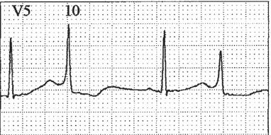 O intervalo QT do complexo QRS, de origem sinusal, é 0,48 s., enquanto o QT corrigido pela fórmula de Bazzett foi 0,51 s., o que define a síndrome de QT longo congênito (SQTLc).