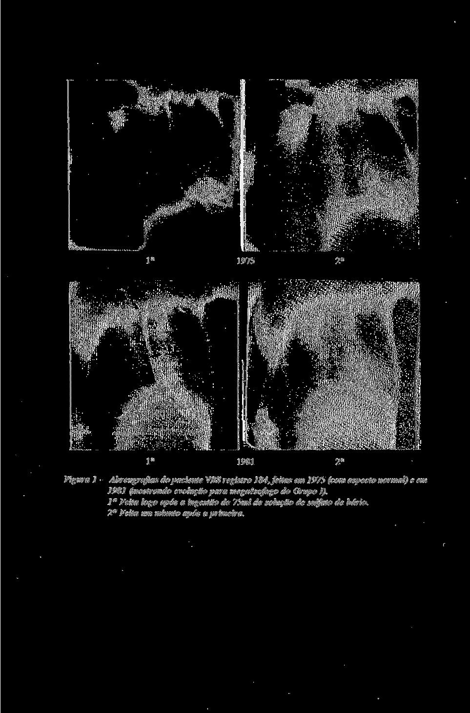 de Chagas, em um período de seis anos. Revista da Sociedade Brasileira de Medicina Tropical 25:225-230, out-dez, casos novos de megaesôfago todos do Grupo I, o que dá uma incidência de 4,5 %.