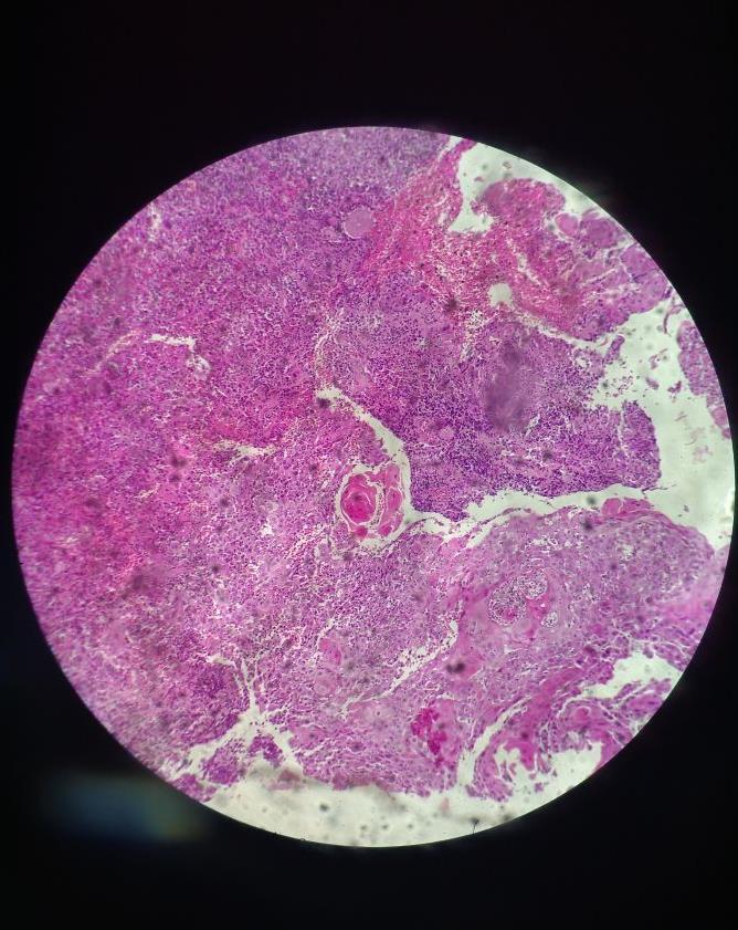 1985 Figura 2 - Lâmina histopatológica de Carcinoma de Células Escamosas submucosa. Em região focal as células se agrupam e formam ilhotas com pérolas de queratina.