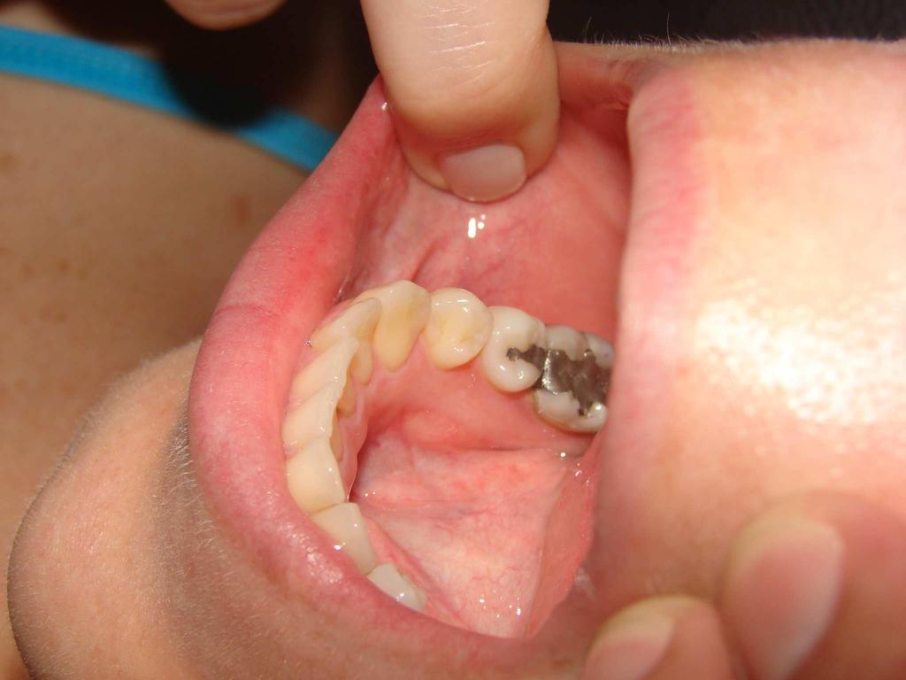B). Figura 9 Dente Hígido Figura 10