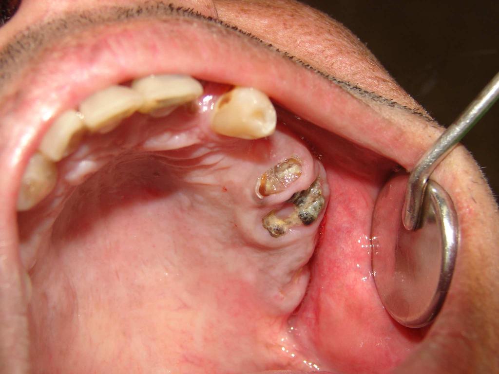 extração indicada Figura 11 Dente