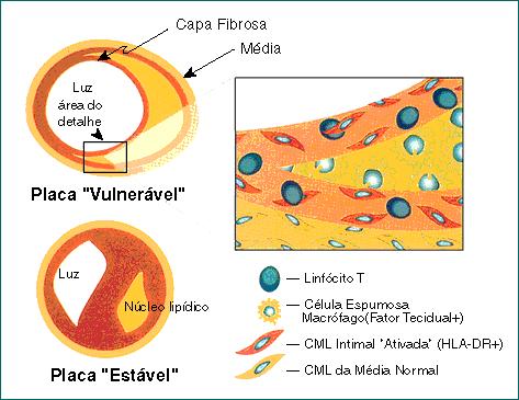 Fisiopatologia Todas as síndromes coronarianas iniciam-se pela