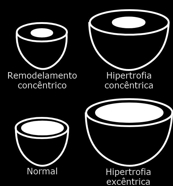 ventrículo esquerdo / dimensão diastólica do ventrículo esquerdo», permite distinguir quatro tipos padrões geométricos ventriculares: geometria normal, hipertrofia concêntrica (aumento da massa