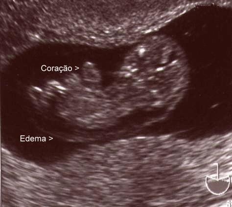 Revisão da Literatura 22 Conseqüentemente, o prognóstico para fetos cromossomicamente normais com edema nucal é reservado 4;6. Figura 9 Edema Nucal.