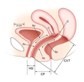 20 pelo POP-Q. O POP-Q é formado por seis pontos definidos dentro da vagina, sendo eles: dois anteriores (Aa e Ba), dois posteriores (Ap e Bp) e dois apicais (C e D).