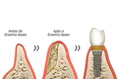 Cirurgias de Levantamento de Seio Maxilar em caso de enxerto ósseo; Preenchimento alveolar em