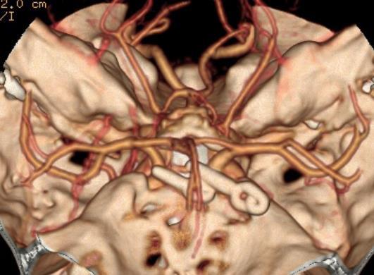 Figura 3. Angio-TC com aneurismas excluídos por clipagem (imagem captada no contexto de controlo pós-operatório no serviço de Neurocirurgia do CHUC).