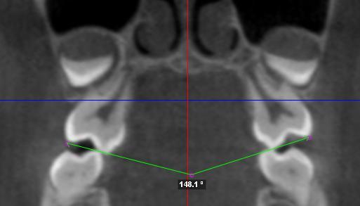 25 adotou-se o posicionamento do septo nasal em sua porção mais superior, perpendicular ao plano horizontal.