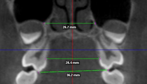 permanente do lado direito (região posterior) e a segunda, localizada 15mm anteriormente da primeira medida (região anterior).