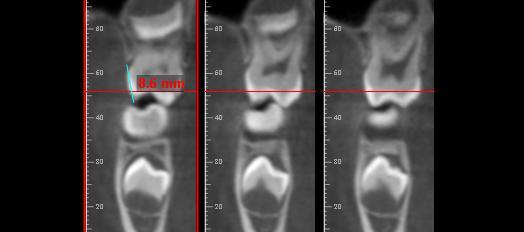 Já o nível da crista óssea vestibular dos dentes 16 e 26 foi aferido por meio de cortes parassagitais. Figura 4 TCFC; A. Região Anterior; B. Inclinação dos Primeiros Molares Permanentes; C.