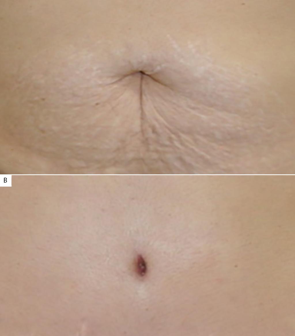 DISCUSSÃO Na abdominoplastia, o adequado posicionamento, associado ao formato da cicatriz umbilical, são fundamentais para um resultado satisfatório8.