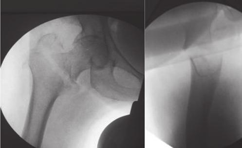 HDA: queda ao nível do solo, que evoluiu com queixa de dor em região de raiz da coxa, encurtamento e rotação lateral de membro inferior direito. Incapacidade de deambular e manter ortostase.