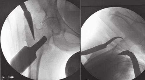 Visão no intensificador de imagem no anteroposterior (esquerda) e no perfil (direita) Após se certificar que conseguiu a redução da fratura nos dois planos, realizada-se a introdução da haste