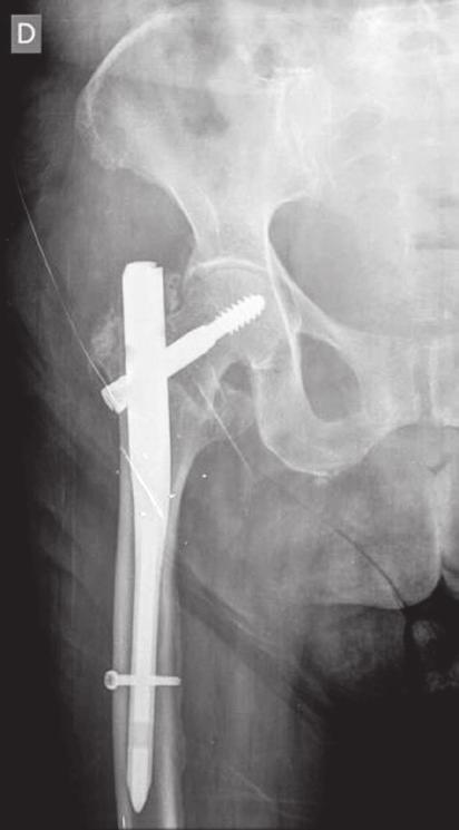 capacidade técnica do cirurgião ortopédico confluirão ao sucesso cirúrgico e boa recuperação do paciente.